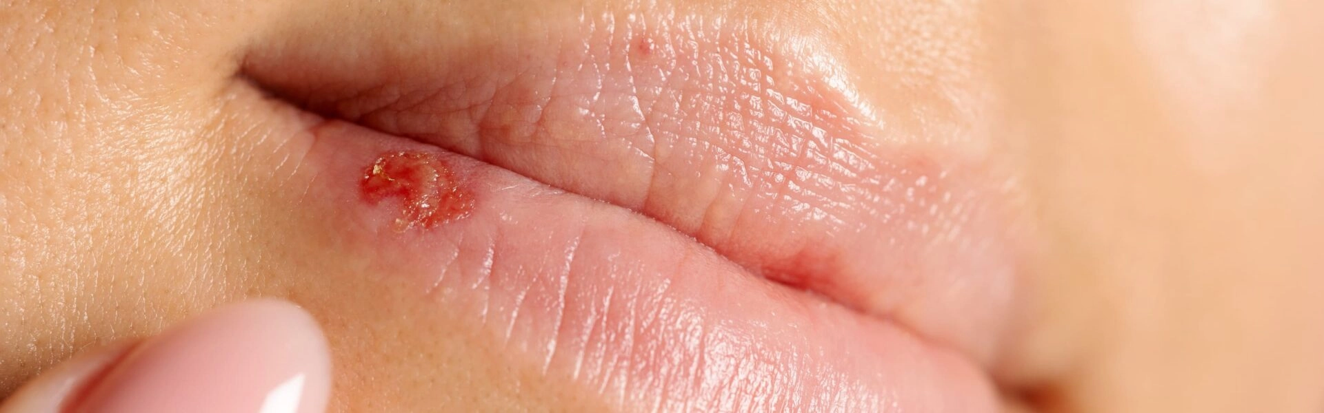 Herpes Labial 